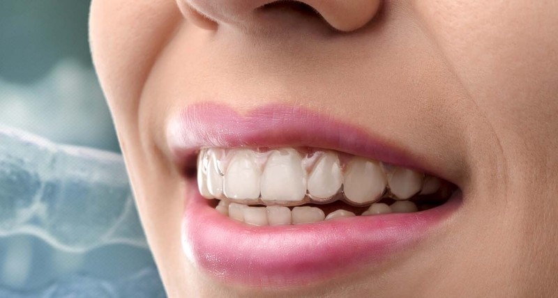 Invisalign