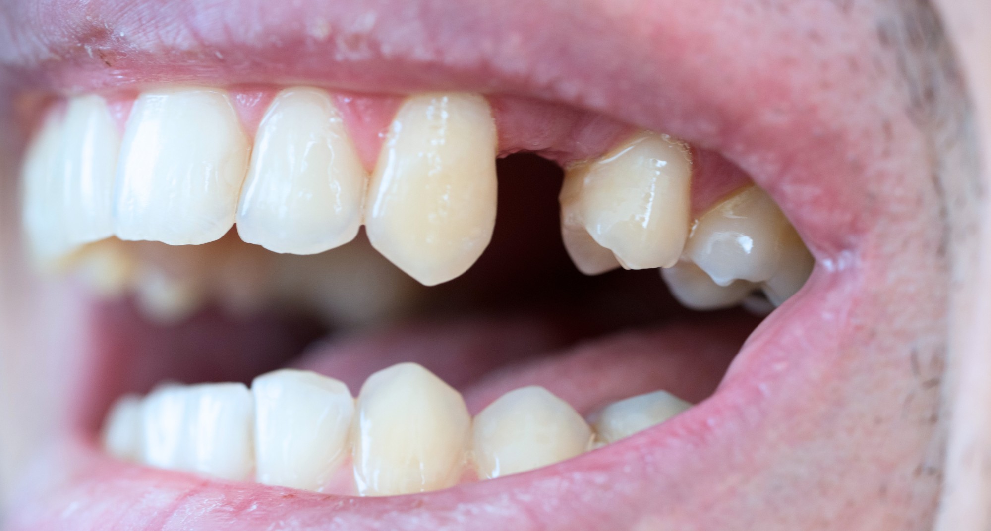 Un solo dente mancante: è davvero necessario intervenire?
