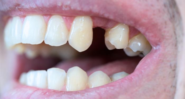 Un solo dente mancante: è davvero necessario intervenire?