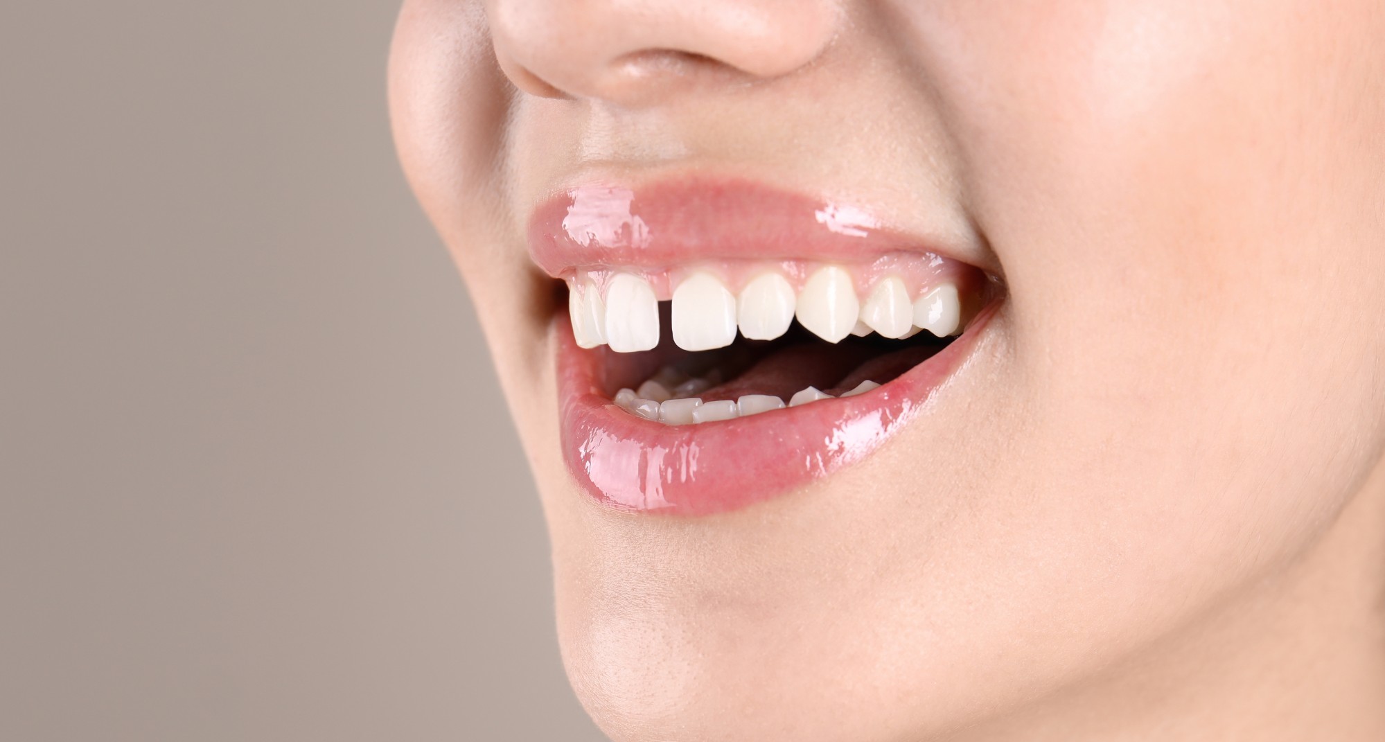Faccette e diastema: come si chiude lo spazio tra i denti?