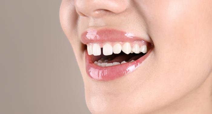 Faccette e diastema: come si chiude lo spazio tra i denti?