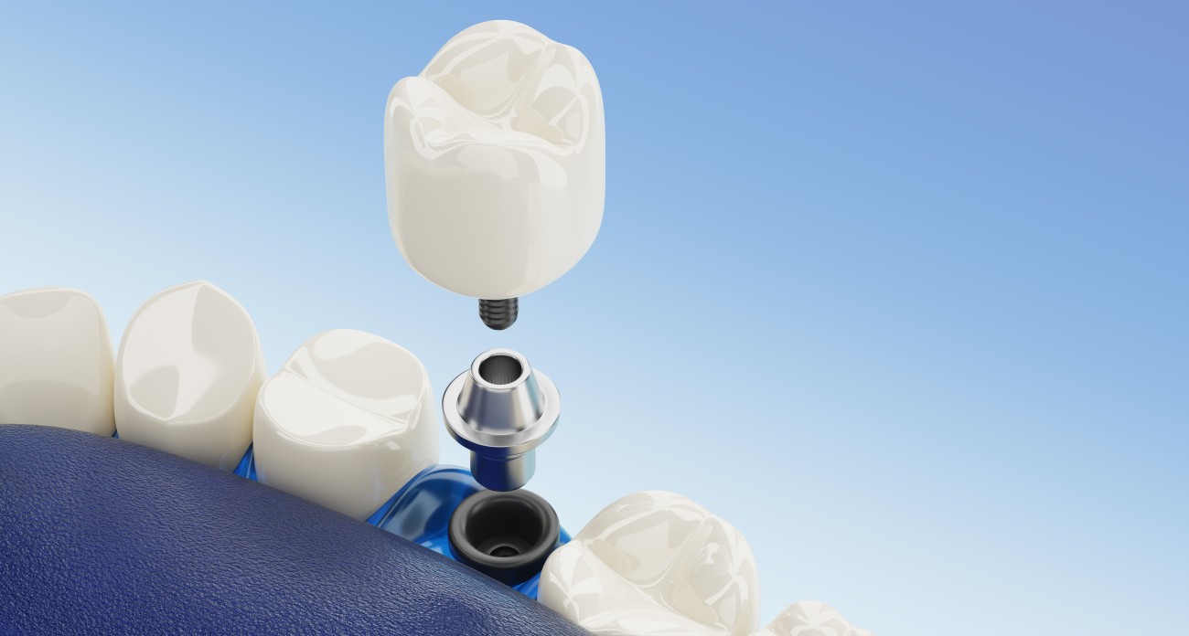 Impianti dentali